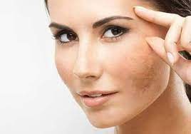 ¿TIENES MANCHAS POR MELASMA?.